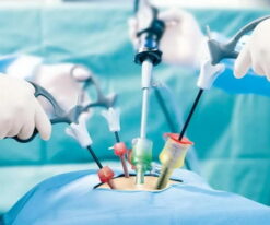 Лапароскопия